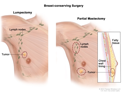 Breast-conserving surgery; drawing shows removal of the tumor and axillary lymph nodes.