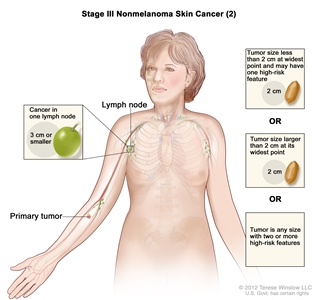 Stage III nonmelanoma skin cancer (2); drawing shows a primary tumor in one arm and cancer in a lymph node on the same side of the body as the primary tumor. Insets show 2 centimeters is about the size of a peanut and 3 centimeters is about the size of a grape.