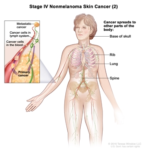 Stage IV nonmelanoma skin cancer (2); drawing shows a primary tumor in one arm and other parts of the body where nonmelanoma skin cancer may spread, including the base of the skull, rib, lung, and spine. An inset shows cancer cells spreading through the blood and lymph system to another part of the body where metastatic cancer has formed.