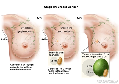 Stage IIA breast cancer. Drawing on the left shows no tumor in the breast, but cancer is found in 3 axillary lymph nodes. Drawing in the middle shows the tumor size is 2 cm or smaller and cancer is found in 3 axillary lymph nodes. Drawing on the right shows the tumor is larger than 2 cm but not larger than 5 cm and has not spread to the lymph nodes.
