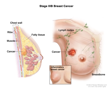Stage IIIB breast cancer. The drawing on the left is a cross section of the breast showing that cancer has spread to the chest wall. The ribs, muscle, and fatty tissue are also shown. The drawing on the right shows the tumor has spread to the skin of the breast. An inset shows inflammatory breast cancer.