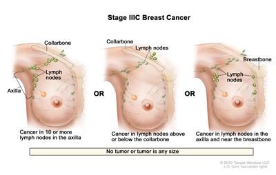 Stage IIIC breast cancer. The drawing on the left shows cancer in lymph nodes in the axilla. The drawing in the middle shows cancer in lymph nodes above the collarbone. The drawing on the right shows cancer in lymph nodes in the axilla and in lymph nodes near the breastbone.