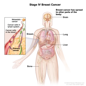 Stage IV breast cancer; drawing shows other parts of the body where breast cancer may spread, including the brain, lung, liver, and bone. An inset shows cancer cells spreading from the breast, through the blood and lymph system, to another part of the body where metastatic cancer has formed.