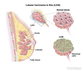 Lobular carcinoma in situ (LCIS); drawing shows a lobe, ducts, lobules, and fatty tissue in a cross section of the breast. Three separate pullouts show a normal lobe, a normal lobule, and a lobule with abnormal cells.