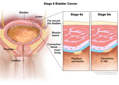 Stage 0 bladder cancer; drawing shows the bladder, ureter, prostate, and urethra. First inset shows papillary carcinoma on the inner lining of the bladder. Second inset shows carcinoma in situ on the inner lining of the bladder. Also shown are the layers of connective tissue and muscle tissue of the bladder and the layer of fat around the bladder.