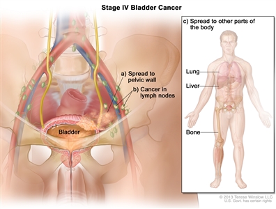 Stage IV bladder cancer; drawing shows cancer in the bladder, the pelvic wall, and lymph nodes. Inset shows some other parts of the body where cancer can spread from the bladder: the lung, liver, and bone.