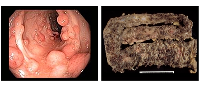 Many polyps protrude from the inner lining of the colon (left panel) and are present on a surgically removed colon (right panel).