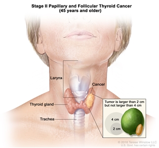 Stage II papillary and follicular thyroid cancer in patients 45 years and older; drawing shows cancer in the thyroid gland. The tumor is larger than 2 centimeters but not larger than 4 centimeters. Also shown are the larynx and trachea.