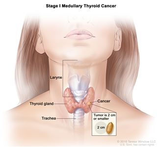 Stage I medullary thyroid cancer; drawing shows cancer in the thyroid gland and the tumor is 2 centimeters or smaller. Also shown are the larynx and trachea.